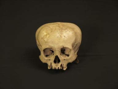 Deformierter Schädel