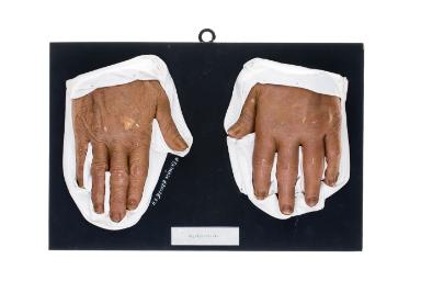 Nagelpsoriasis