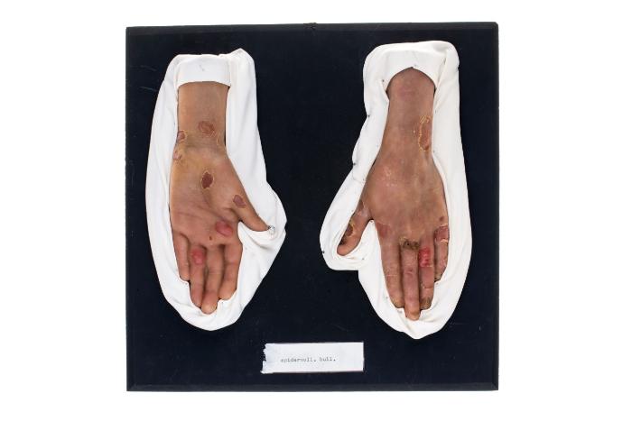 Epidermolysis bullosa