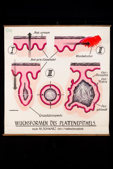 Wuchsformen des Plattenepithels nach M. Schwarz