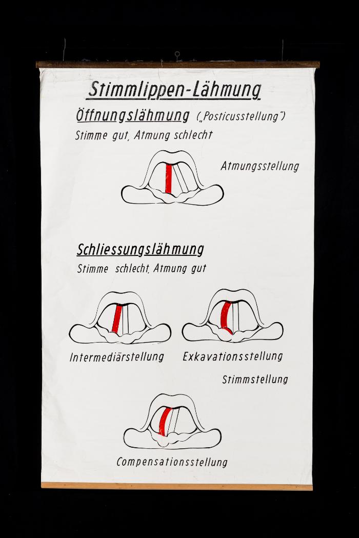 Schema der Stimmlippen-Lähmungen