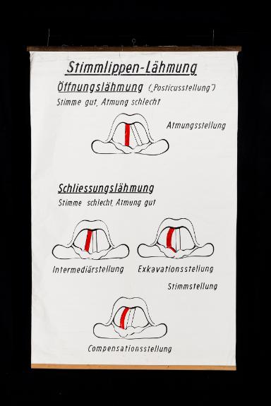 Schema der Stimmlippen-Lähmungen