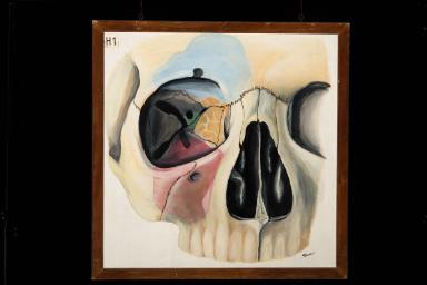 Knöcherne Anatomie des Gesichtsschädels und der Augenhöhle (Orbita) mit Bezug zu den Nasennebenhöhlen