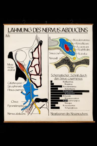 Lähmung des Nervus Abducens