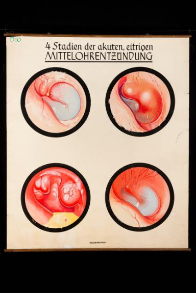 4 Stadien der akuten, eitrigen Mittelohrentzündung
