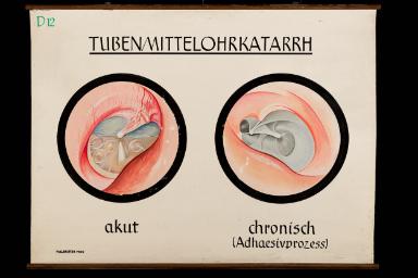 Tubenmittelohrkatarrh