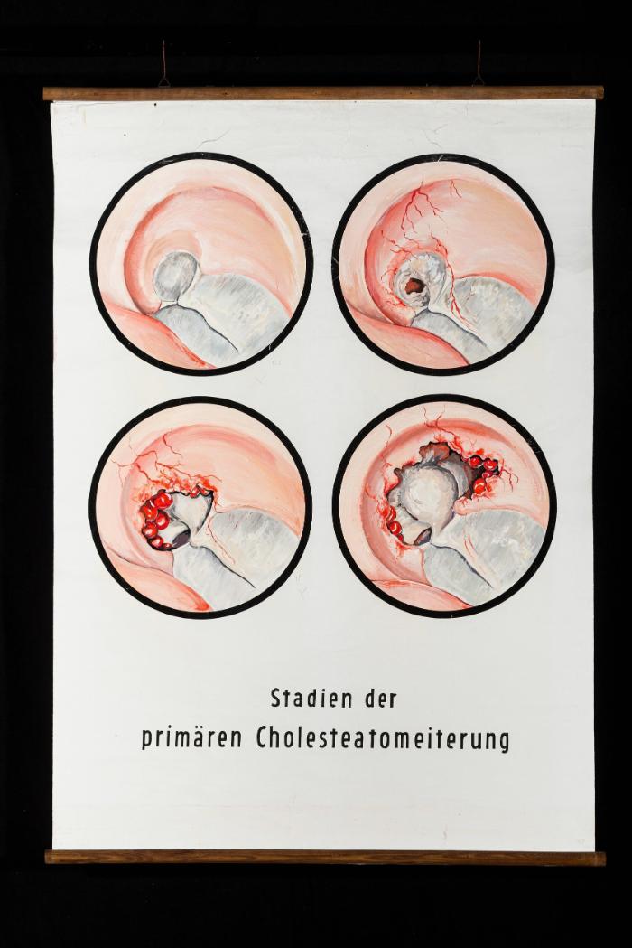 Stadien der primären Cholesteatomeiterung