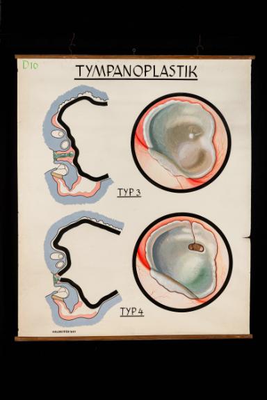 Tympanoplastik, Typ 3 und 4