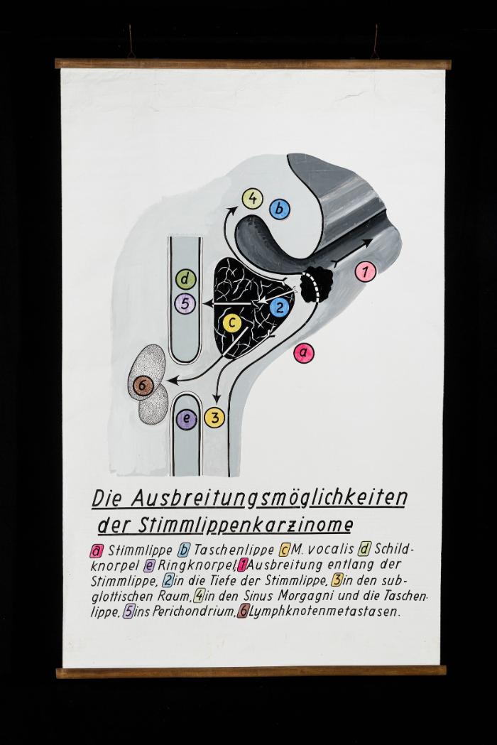 Die Metastasierung der Stimmlippenkarzinome