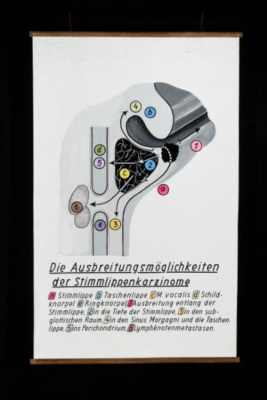 Die Metastasierung der Stimmlippenkarzinome