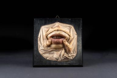 Plaques muqueuses (Lues)
