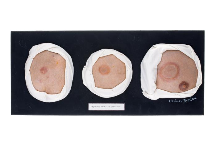 Erythema annulare perstans
