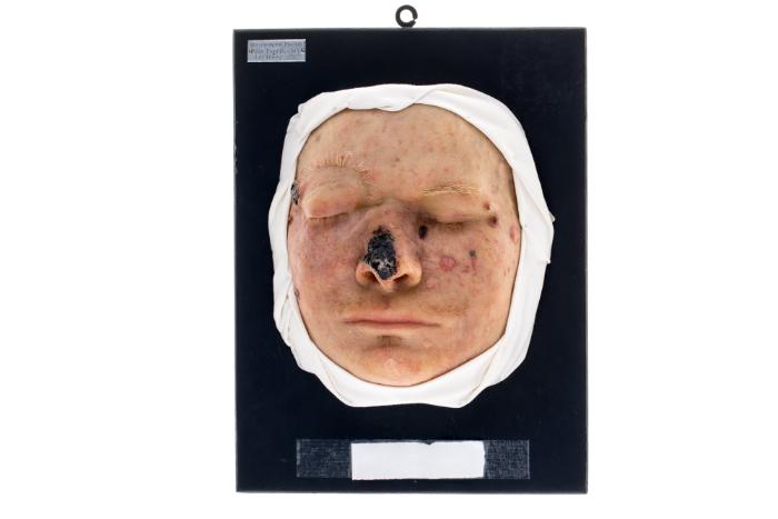 Xeroderma pigmentosum