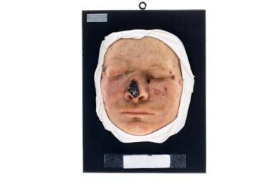 Xeroderma pigmentosum