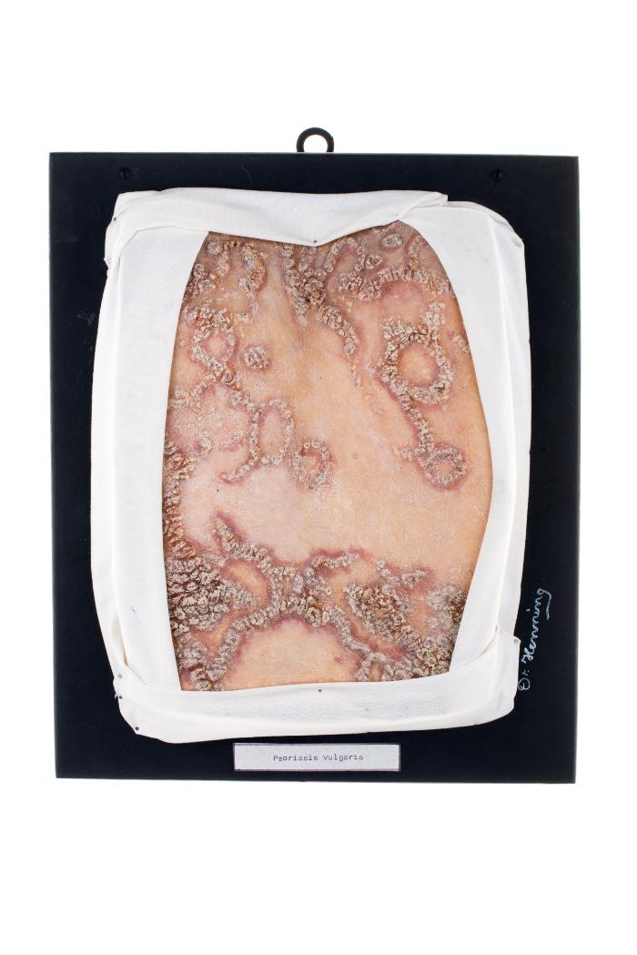 Psoriasis vulgaris