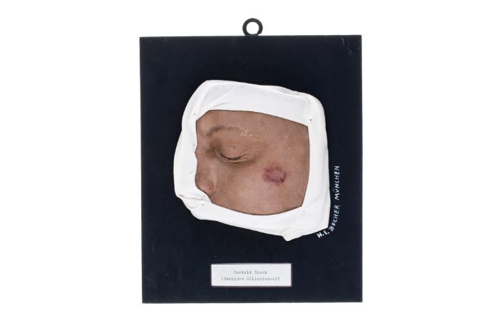 Boecksches Sarkoid