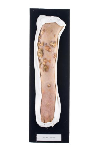 Psoriasis vulgaris