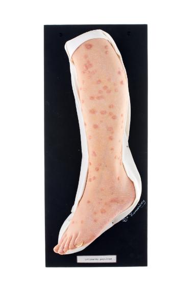 Urticaria