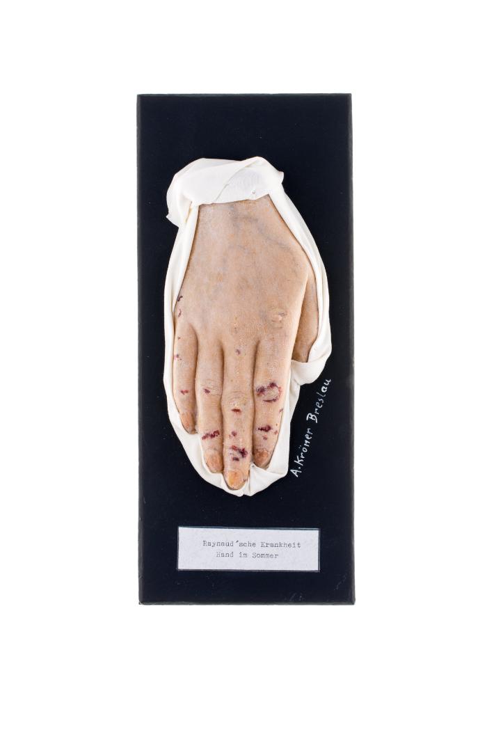 Raynaud'sche Krankheit