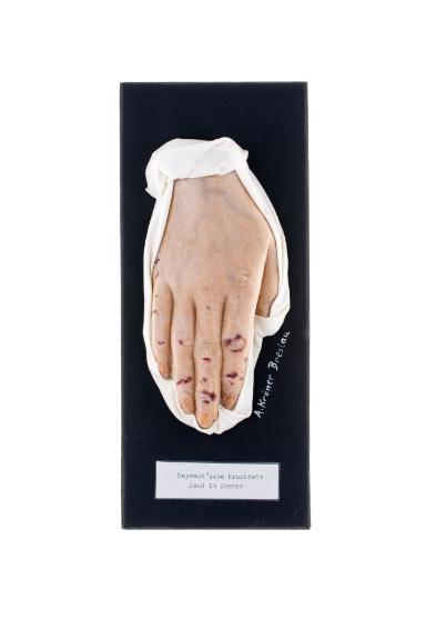Raynaud'sche Krankheit