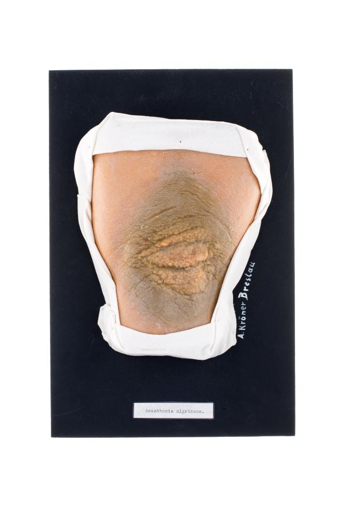 Acanthosis nigricans