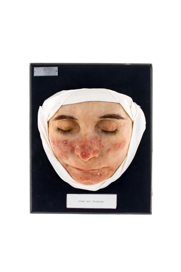 Akne und Rosacea